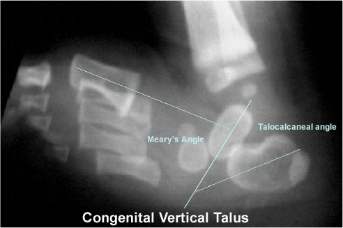 calcaneovalgus foot